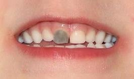 O que pode levar um dente de leite ficar escuro? – Ortopretti