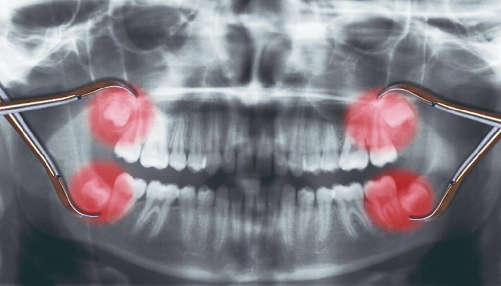 Quanto custa para “tirar” o dente do siso? – Ortopretti